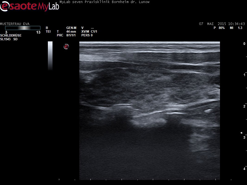 Mittels einer Sonographie der Schilddrüse lassen sich Veränderungen in der Binnenstruktur des Organs feststellen.