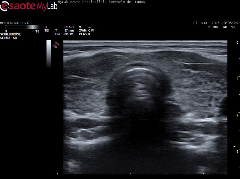 Die Ultraschalluntersuchung der Schilddrüse ist bei Hashimoto-Thyreoiditis auch zur Verlaufskontrolle von großer Bedeutung.