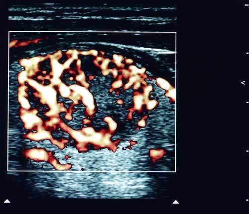 Ultraschall Schilddruesenkrebs bei Hashimoto Thyreoiditis