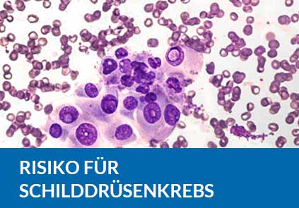 Hashimoto Thyreoiditis erhöht das Risiko für Schilddrüsenkrebs