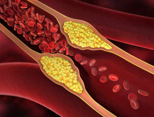 Hashimoto-Thyreoiditis erhöht das Risiko für Herzerkrankungen